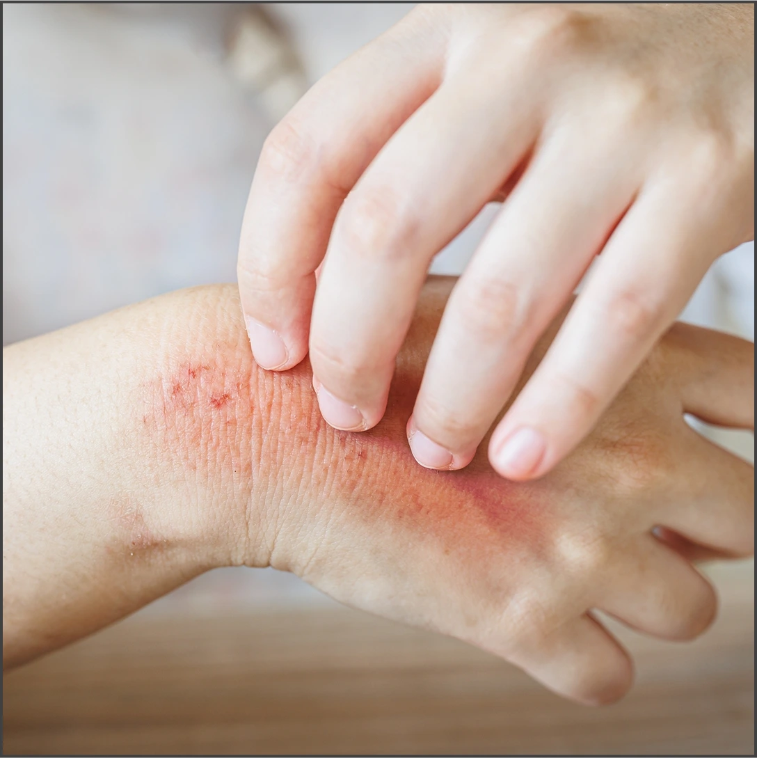 Dry, flaky skin